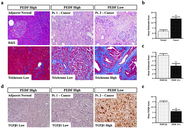PEDF expression negatively correlates with fibrosis in human pancreatic cancer specimens.