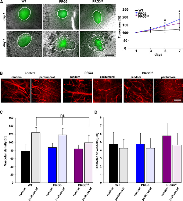 Imbalanced PRG3 levels drive glioma invasion but not tumor angiogenesis.