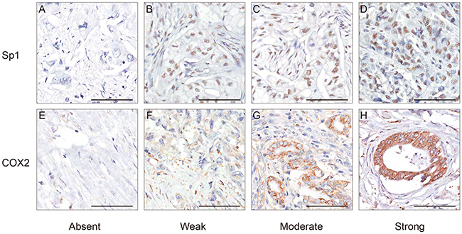 Representative immunohistochemical staining of Sp1 and COX2 in PDAC.