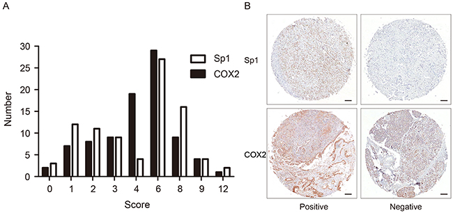 The distribution pattern and representative images of Sp1- and COX2- positive/negative expression.