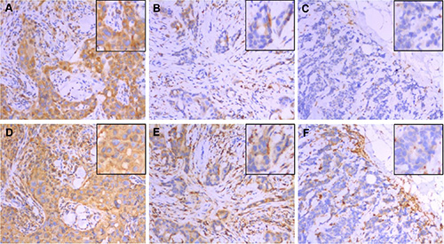 Expression of CD74 (top row) and MHCII (bottom row) in the same areas of three representative tumors as determined by immunohistochemistry.