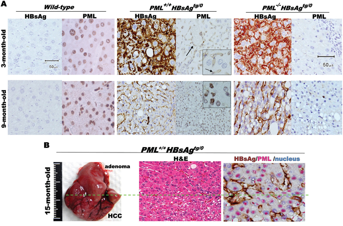 Mutually exclusive interactive patterns between PML and HBsAg in HBsAg-transgenic mice.