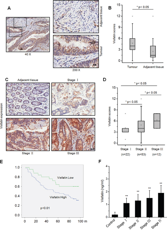 Visfatin expression in clinical samples of colorectal cancer patients.