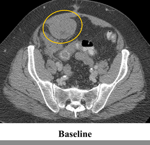 Tumor regression of 20% observed in abdominal and pelvic tumors on computerized tomography (CT).