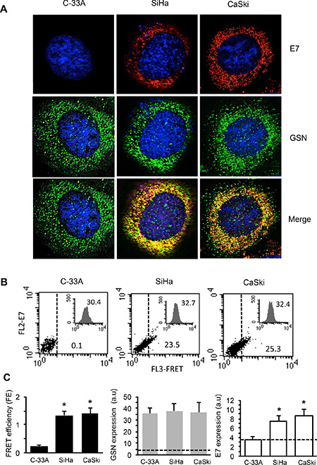 E7 interacts with GSN in carcinoma cells.