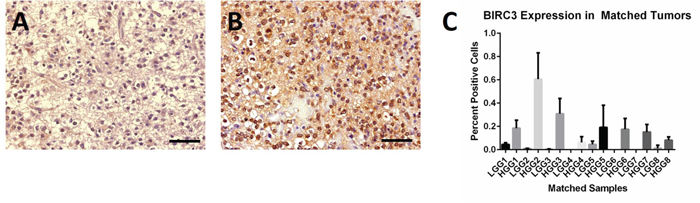 Expression of BIRC3 in representative human low-grade glioma and subsequent high-grade glioma.