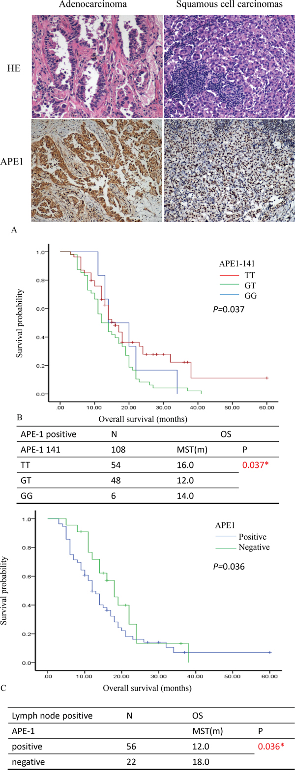 APE1 expression predicts survival prognosis of patients with NSCLC.
