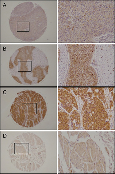 Immunohistochemical staining of UHRF1 in BC clinical specimens.