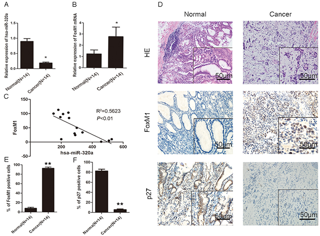 Association of miR-320a reduced expression and increased FoxM1 expression with the inhibition of P27KIP1 in human gastric cancer.