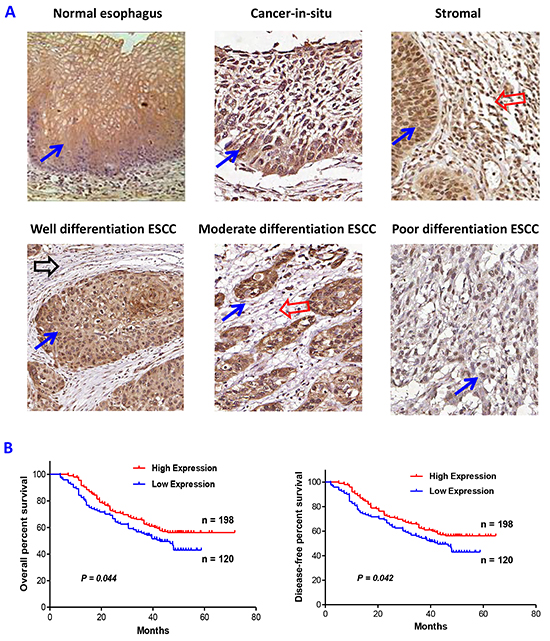 Altered expression of PRSS8 in esophageal squamous cell carcinoma (ESCC).