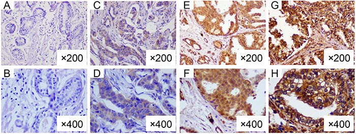 Representative immunohistochemical staining of CCR3 in breast cancers.