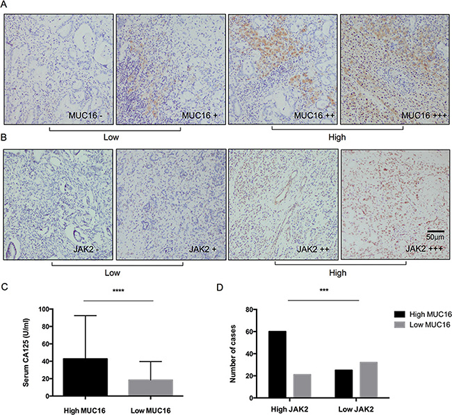 Expressions of mucin-16 (MUC16) and JAK2 in pancreatic cancer tissues from patients with LN16 metastasis.