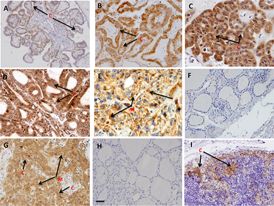 Immunohistochemical analysis of PD-L1 in thyroid tissues: Paraffin embedded sections of different stages of PTC, benign thyroid nodules and concurrent thyroiditis were stained using anti-PD-L1 monoclonal antibody as described in the method sections.