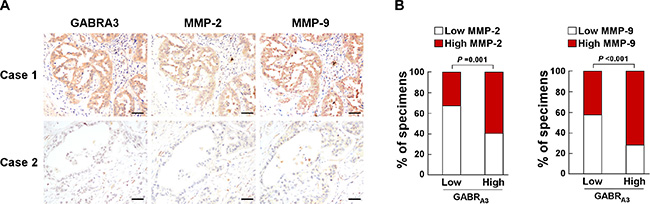Clinical relevance between GABRA3 and MMP-2/MMP-9 expression in human LUAD.