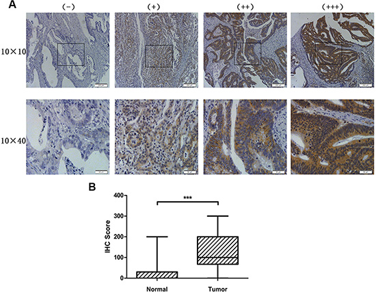 HOXC6 was highly expressed in CRC tumor tissues.