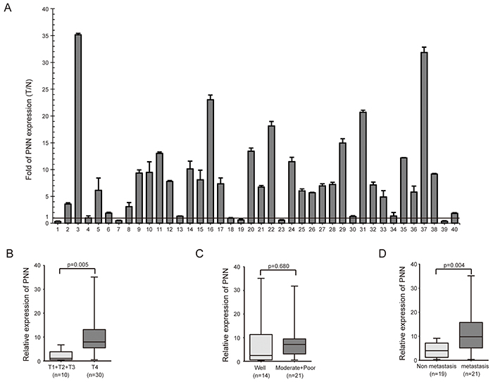 PNN is highly expressed in CRC and correlated with T classification and metastasis.