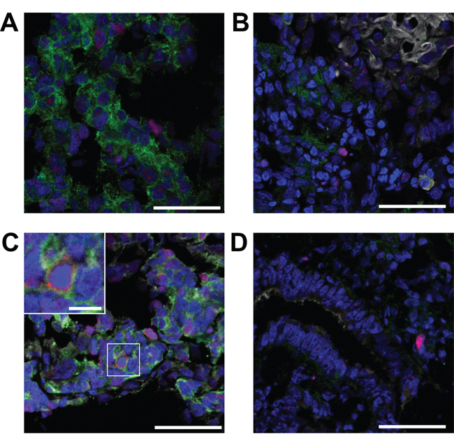 Representative MUC1 and EGFR staining patterns observed in human tumors.