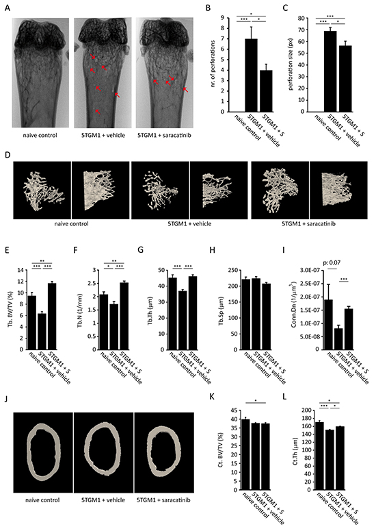 Effect of saracatinib treatment on the development of bone disease in the 5TGM.1 multiple myeloma model.