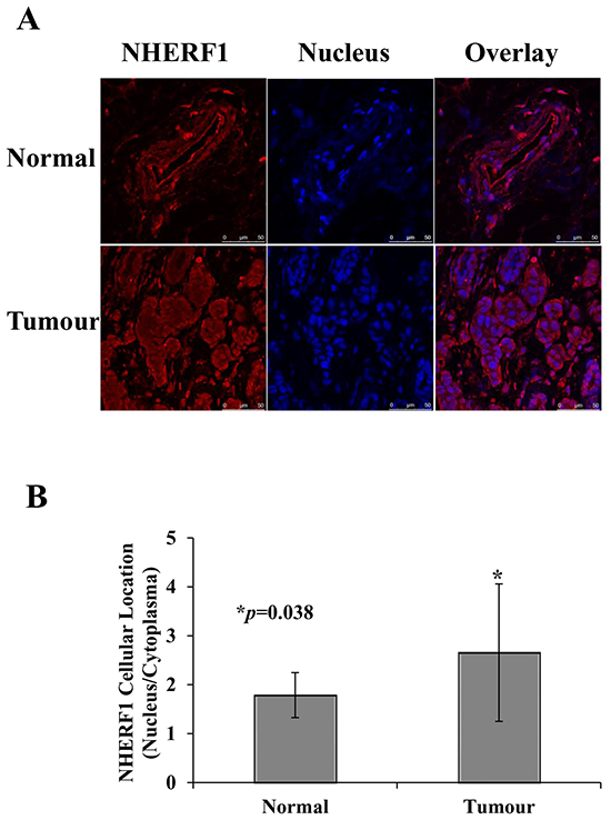 Subcellular distribution of NHERF1 in normal and cancerous human breast tissues.