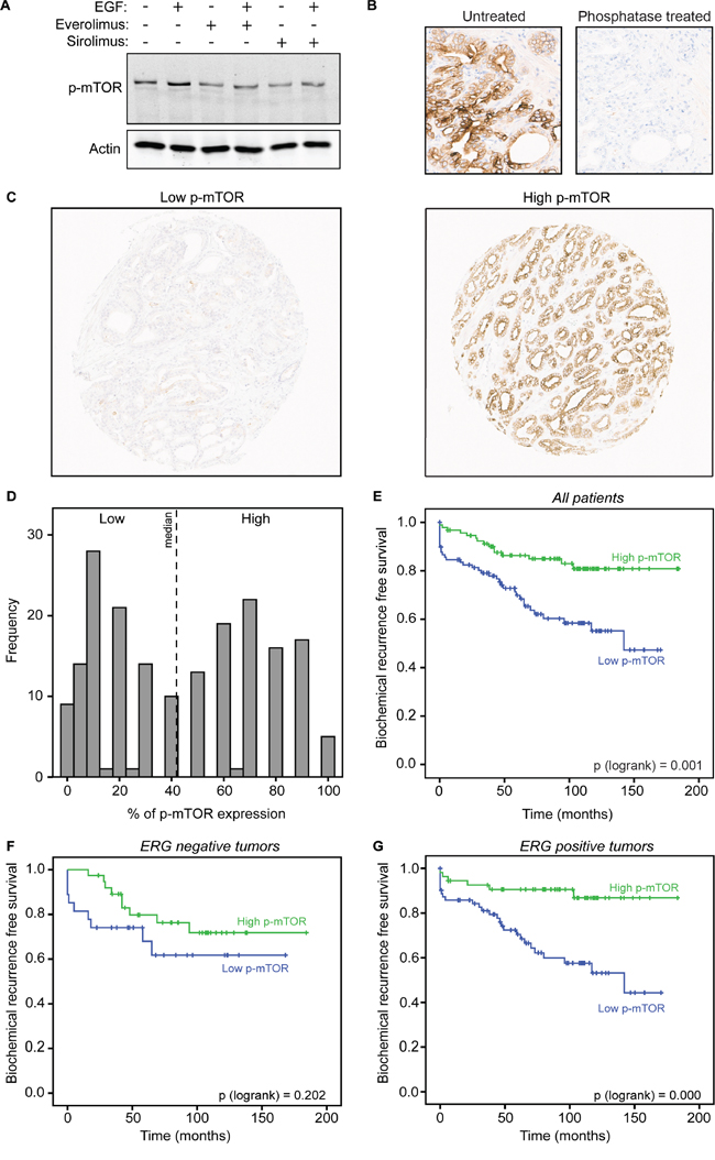 p-mTOR expression in tumor cells identifies prostate cancer patients with favorable outcome