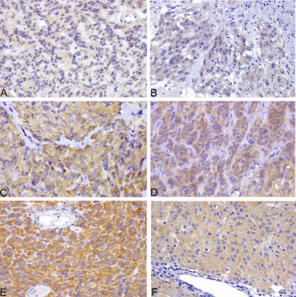 All six BRAF V600E-mutated GIST of the series were VE1 positive, with weak cytoplasmic staining in two cases (A,B), moderate staining in two cases (C, F) and strong staining in two cases (D, E).
