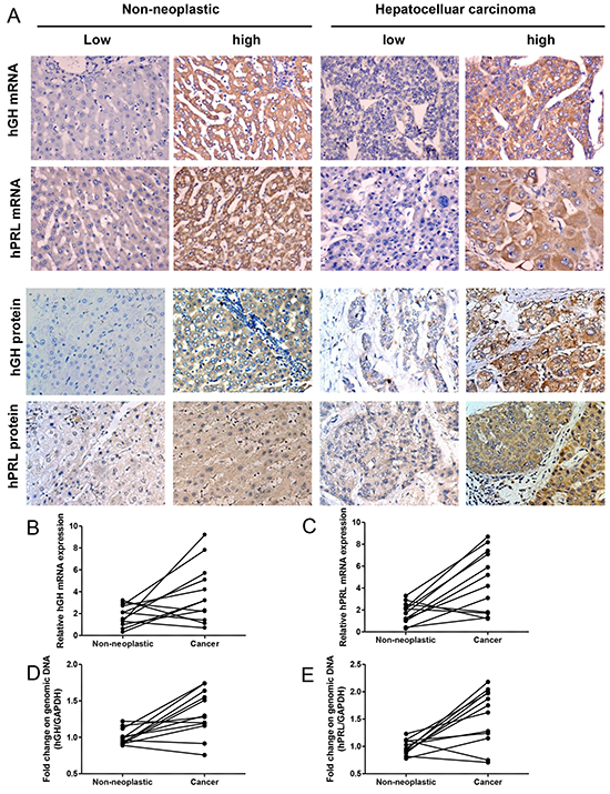 hGH or hPRL expression in hepatic non-neoplastic tissue and hepatocellular carcinoma.