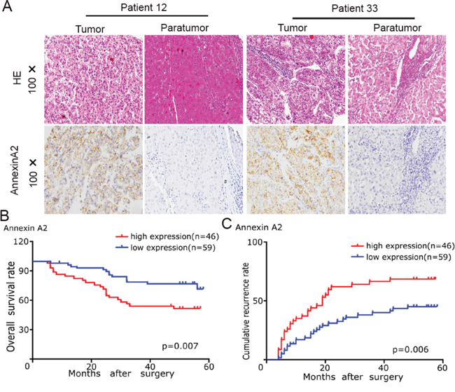 The Annexin A2 expression and its clinical significance in HCC patients.