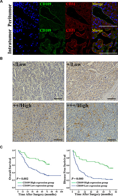 Reduced expression of CD109 on tumor vessels correlated with poor survival in HCC patients.