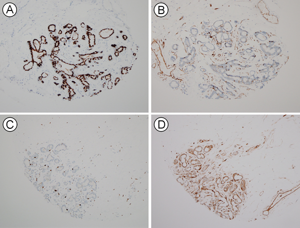 HLA-ABC and ER expression in normal breast luminal cells.