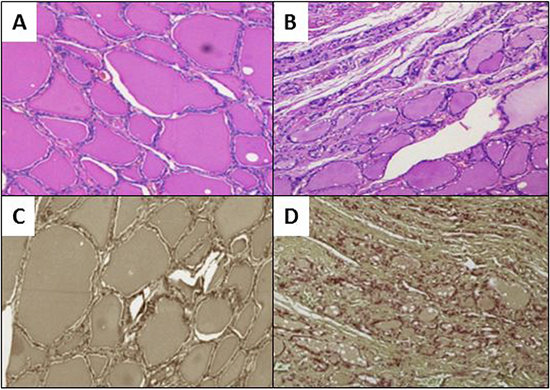 Evaluation of neoplastic infiltration.