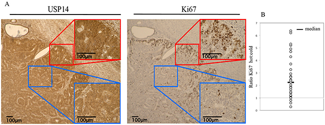 USP14 is overexpressed in proliferating endometrial cancer cells in situ.