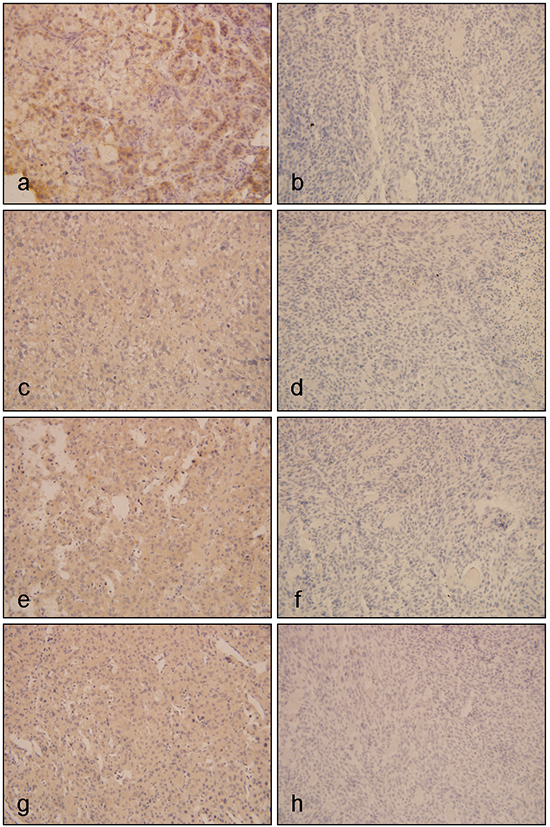 Immunohistochemistical results of EGFR, IGF1R and its downstream proteins in ACTs.