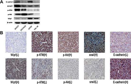 Correlation of Wip1with p-ATM, p-AKT, snail and E-cadherin in ovarian cancer tissues.