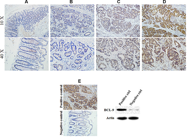 BCL-9 expression in different developing stages of colorectal cancer tissue.