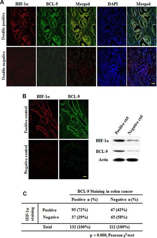 HIF-1&#x03B1; expression is associated with BCL-9 expression in human colorectal cancer specimens.