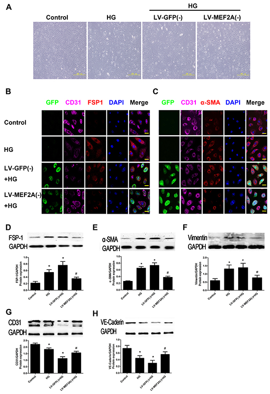MEF2A inhibition limits HG-induced EndMT in HUVECs.