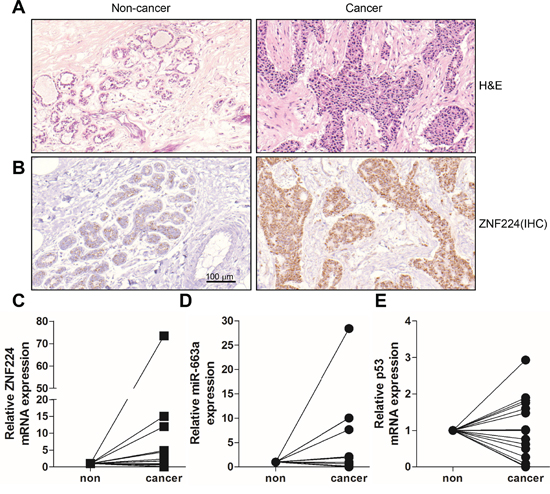 Expression analyses in human breast cancer.