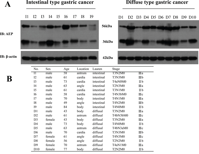 The expression of AEP was higher in diffuse type gastric cancer than that in intestinal type gastric cancer.