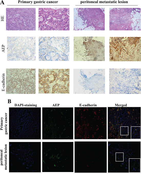 AEP and E-cadherin expression were detected both in primary gastric cancer and peritoneal metastatic loci.