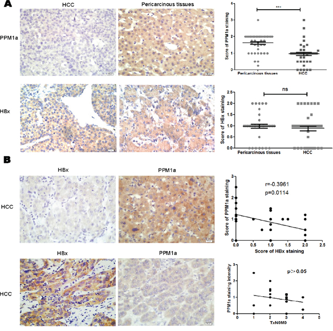 Negative correlation between HBx and PPM1a expression in HCC tissue.