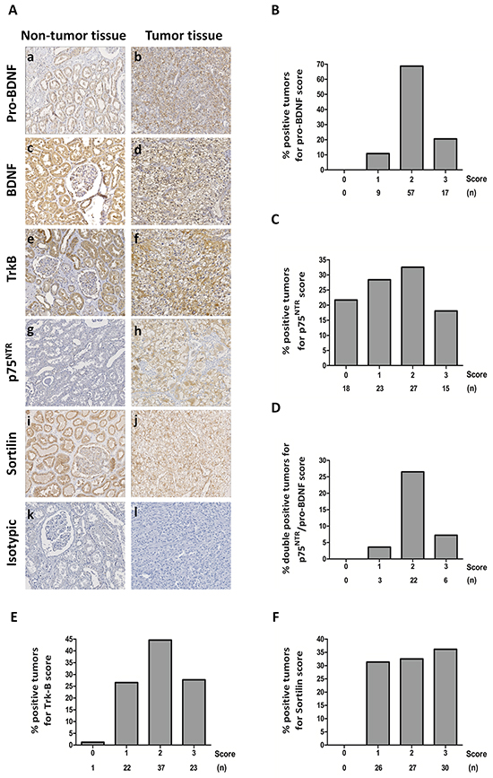 Immunohistochemical staining on clear cell RCC tumors and normal tissues.