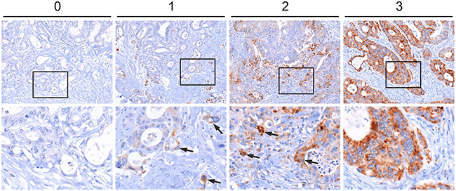 Immunostaining of CYB5R1 in colorectal cancer.