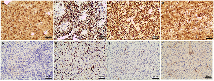 Examples of IDH-1R132H mut, Ki-67 index, and mutant p53 and MGMT protein levels in glioblastomas.