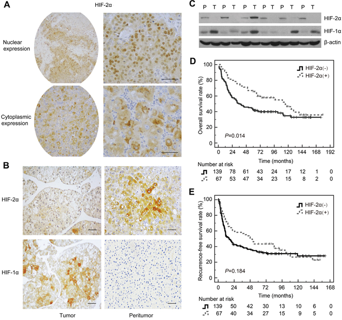 Expression of HIF-2&#x03B1; in HCC tissues and the correlation with prognosis.