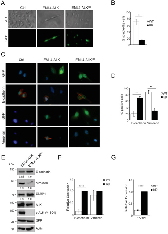 EML4-ALK ectopic expression in immortalized bronchial epithelial cells induces a mesenchymal phenotype.