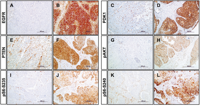 Immunohistochemical analysis of PI3K pathway proteins in HNSCC tissue specimens.