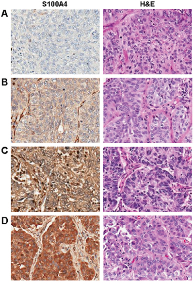 S100A4 expression patterns in non-small cell lung carcinoma.