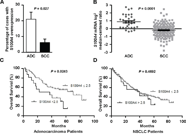 S100A4 is overexpressed in lung adenocarcinoma, where it associates with decreased overall survival.