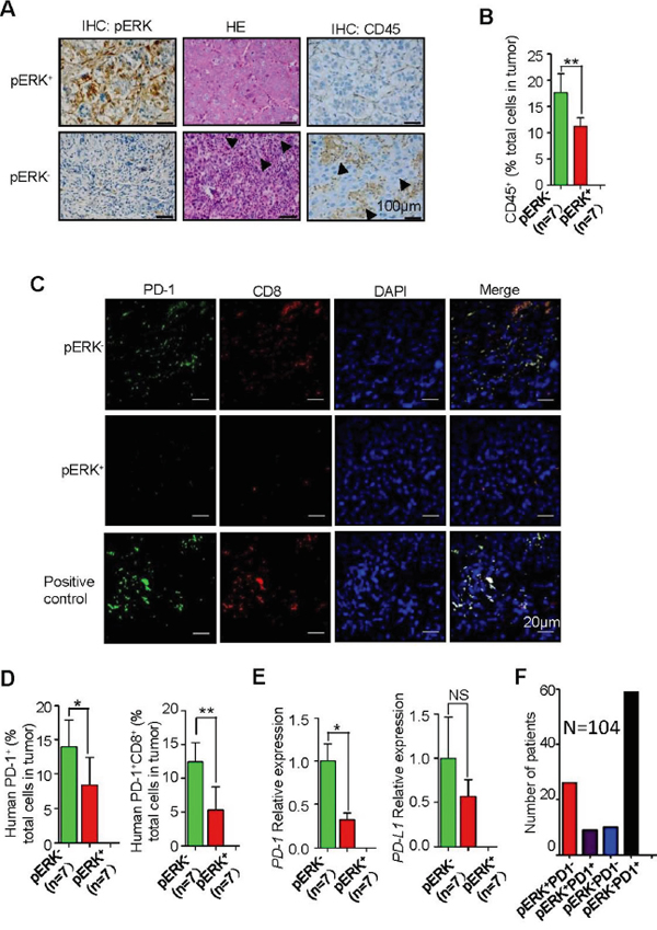 Increased inflammation and intratumoral PD-1+CD8+ T lymphocytes in pERK- HCC samples.