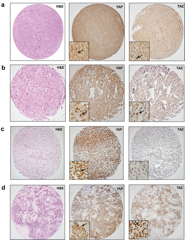 YAP and TAZ are widely expressed and activated (nuclear localization) across multiple histological sarcoma types.